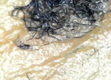 The Silent Pandemic – Morgellons Disease Hiding in Plain sight – The Blob, Aspergillus fumigatus